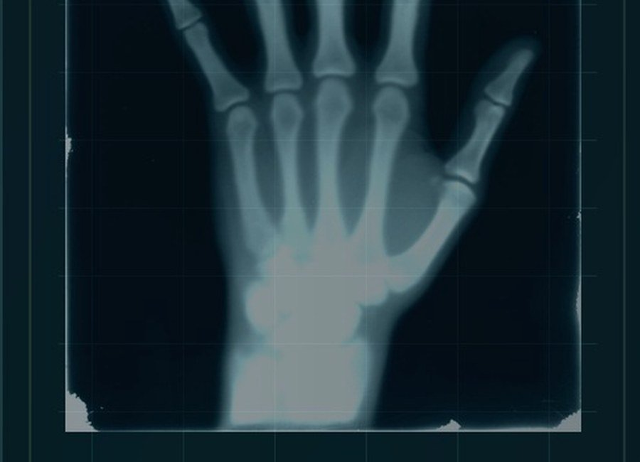 Wrist Arthroscopy medical procedure visual