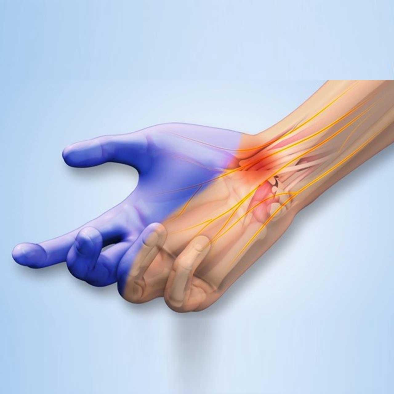 Carpal Tunnel Syndrome: Symptoms, Causes, and Treatment Options